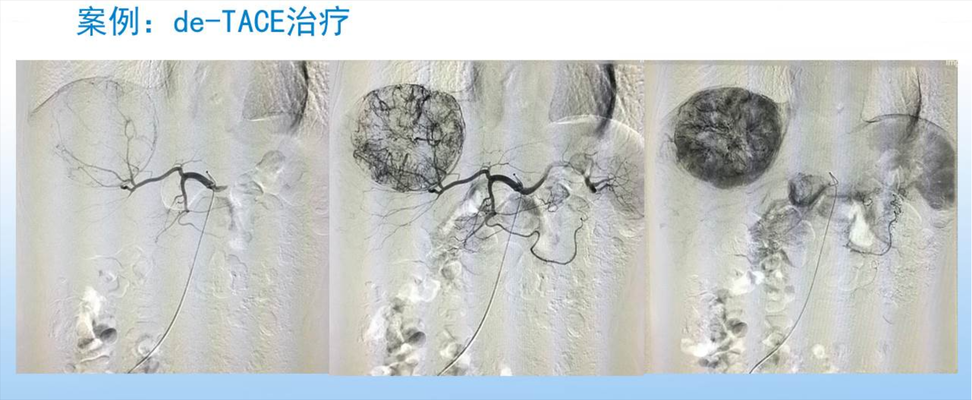介入治肿瘤 微创新技术